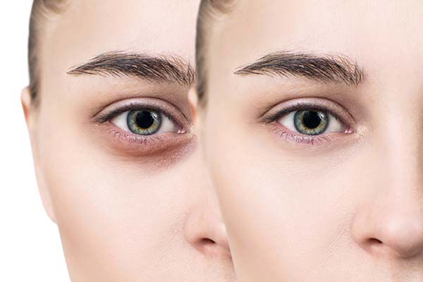Get to know the terms Dark Circle, Eye Bags, and Puffy Eyes