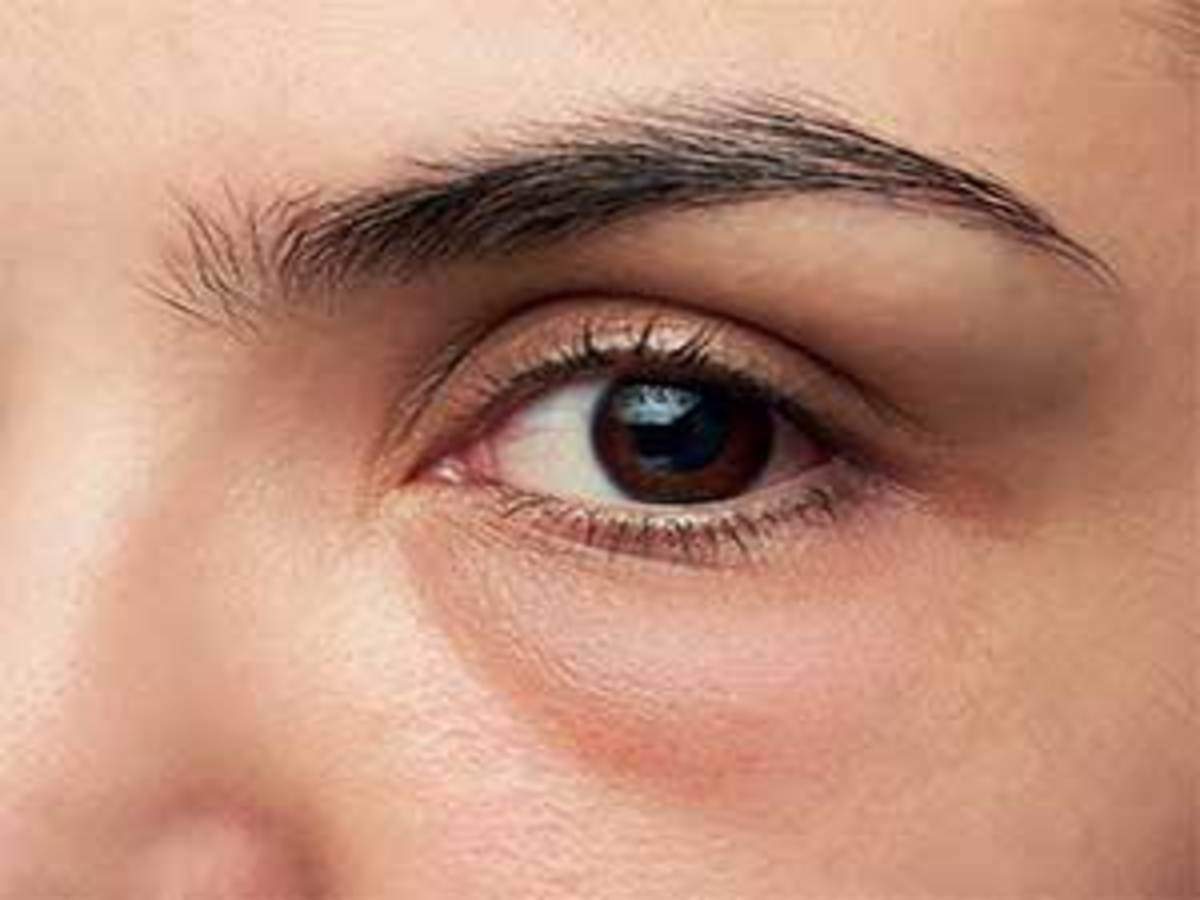 10 Things About Puffy Eyes and How To Overcome Them, Different From Dark Circles