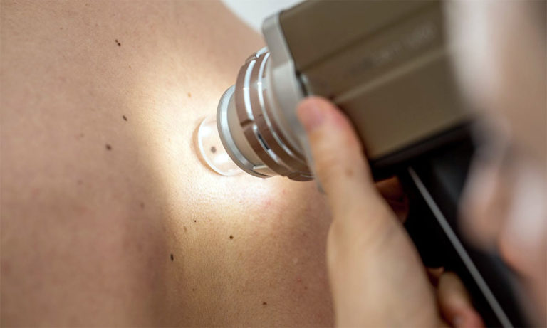 5 Facts about Moles, Could Be a Sign of a Disease